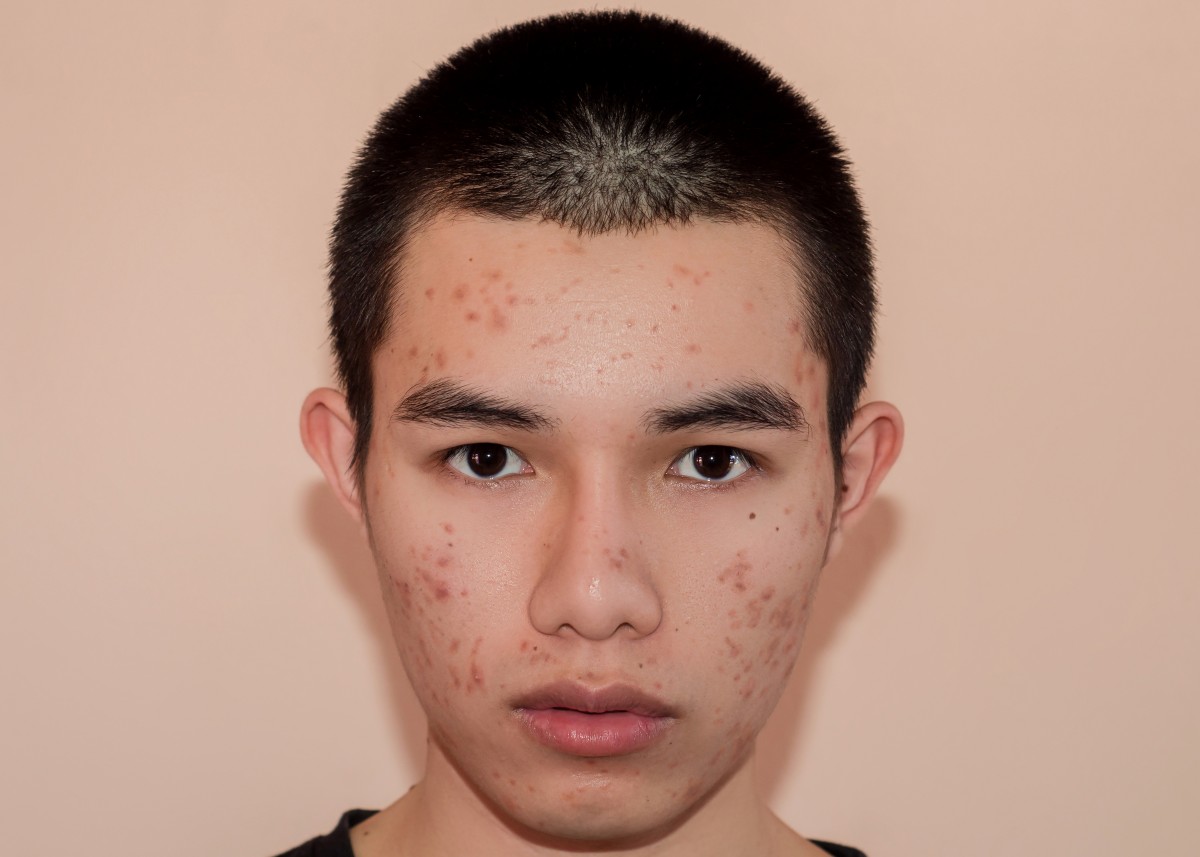 man pimple face